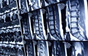 spinal cord injury